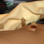 Moxibustion - Akupunktur